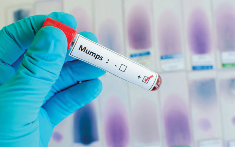 Mumps outbreak prompts vaccination reminder